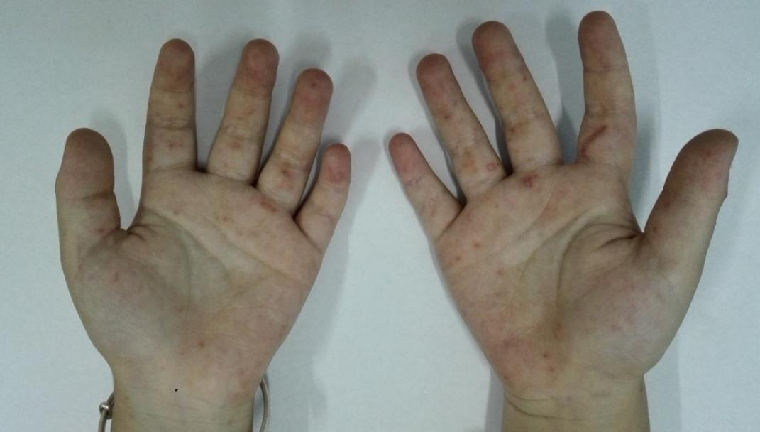 六岁孩子身上出现小红点要警惕,女童身上出现小红点