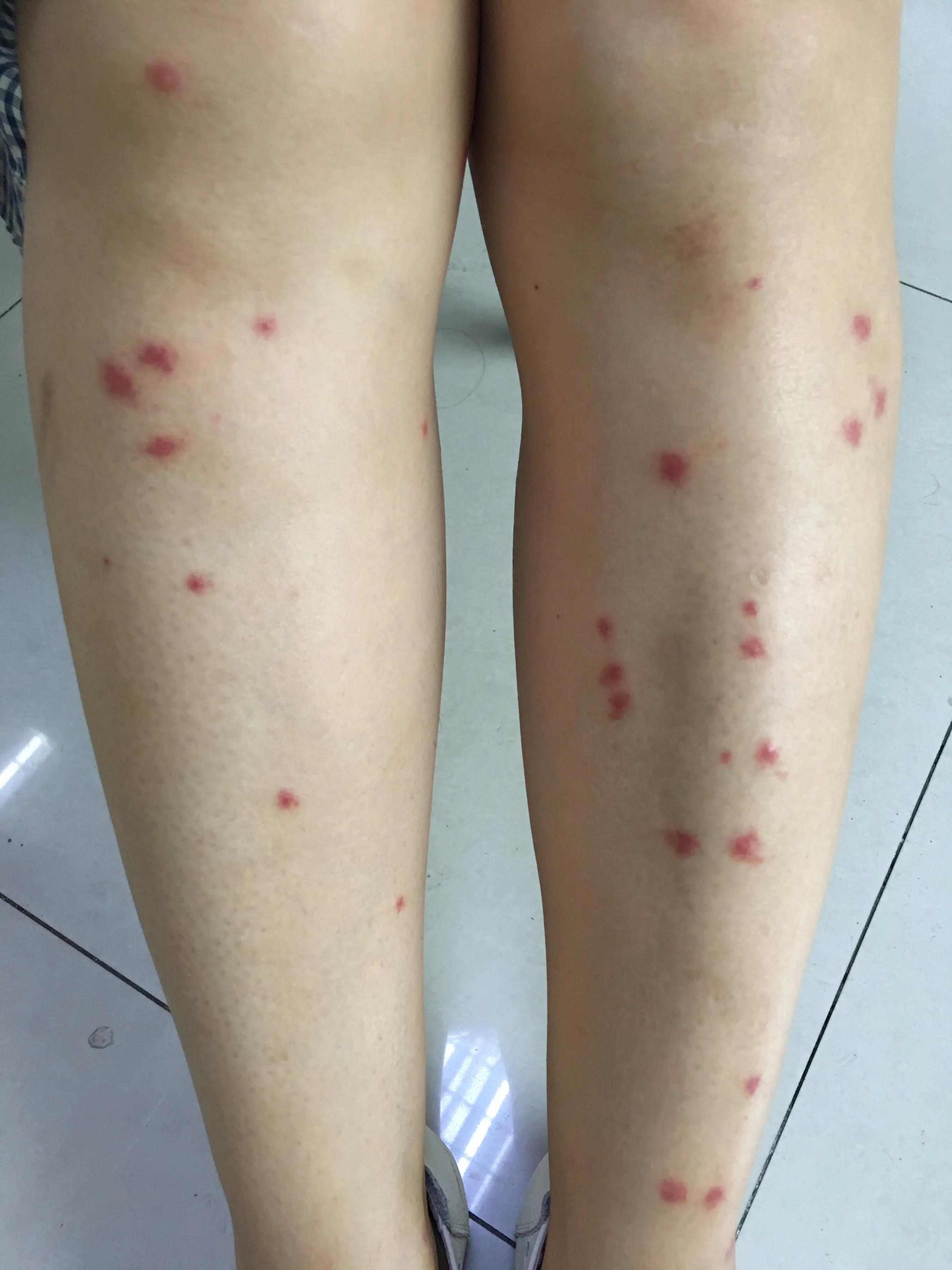 皮肤科专家支招如何应对虫咬皮炎,虫咬性皮炎几个不典型的皮肤症状