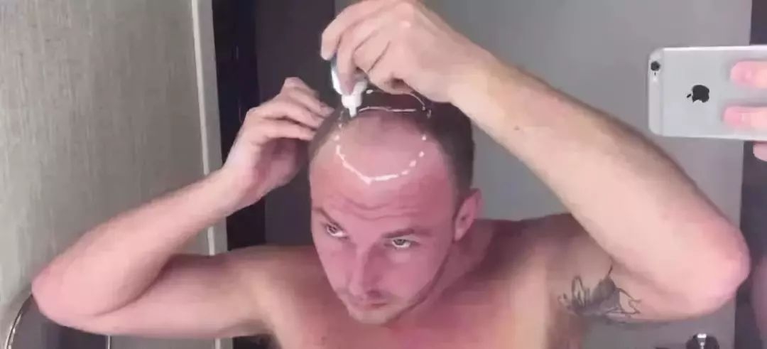 90后“未富先秃”！该拿什么拯救我的发际线？