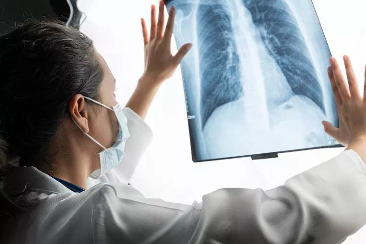 肺癌治疗的靶向药降价了吗,肺癌哪些靶向药物是医保的