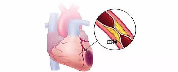 血管狭窄用药可以改善吗,老人血管狭窄吃什么药疏通