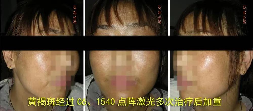 褐斑吃什么药能根除,除褐斑的办法