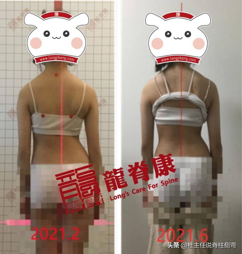 13岁女孩脊柱侧弯能治愈吗,13岁女孩脊柱侧弯21度还能矫正吗