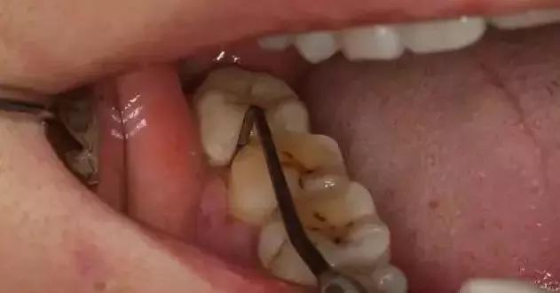 深度洗牙和普通洗牙,洗牙深度洁治和上药大概多少钱