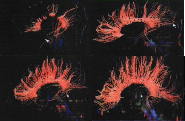 磁共振dti融合成像,磁共振dti成像作用