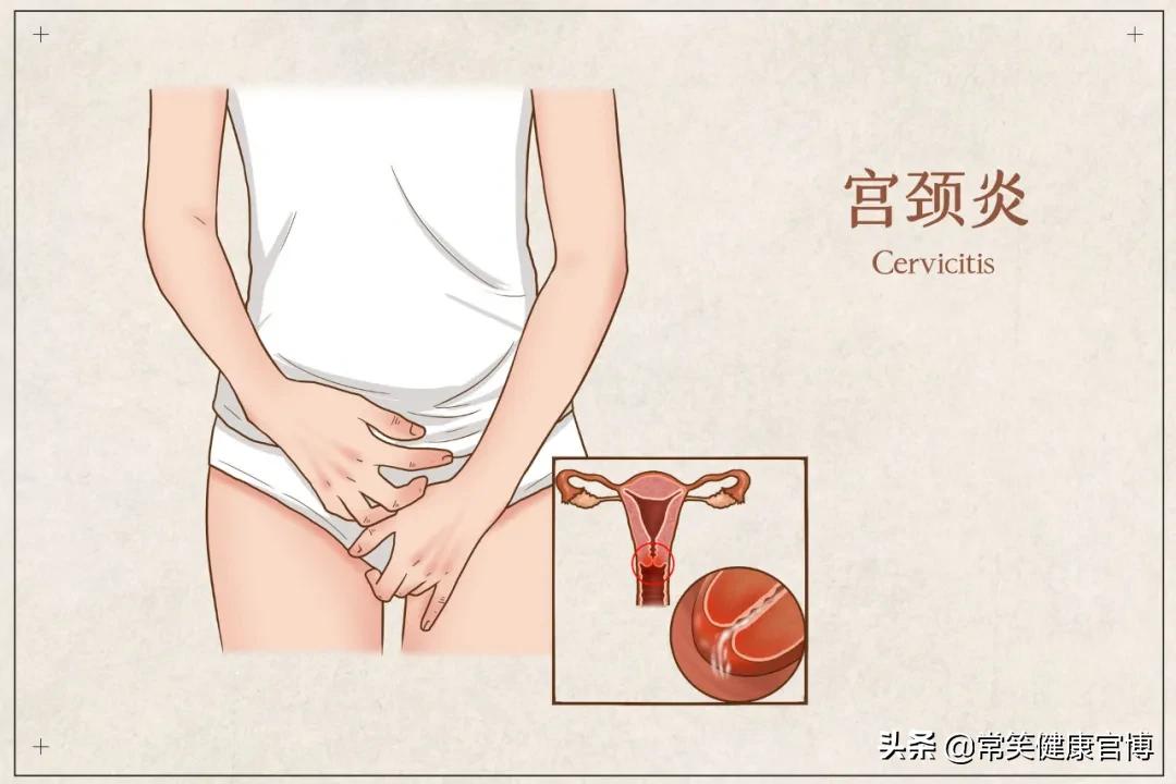 怎么才不容易得宫颈炎,得了宫颈病变丢人吗