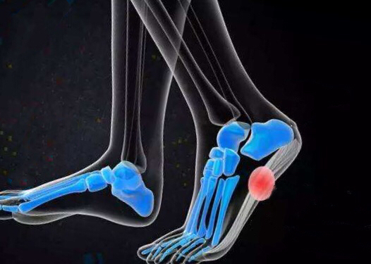 产后3个月睡醒脚后跟疼怎么回事,产后脚后跟疼一招解决