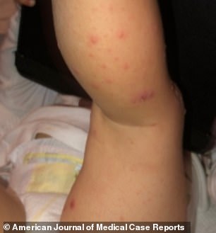 抗病毒治疗阿昔洛韦,抗病毒药膏阿昔洛韦