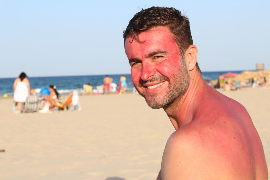 出来晒太阳皮肤变红了,为什么皮肤被太阳晒后就发红发痒