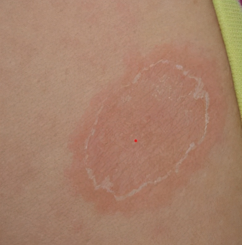 皮肤病玫瑰糠疹,玫瑰糠疹皮肤病