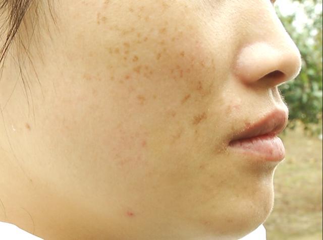 江西南昌荣美会祛斑,美容院祛斑毁容案例