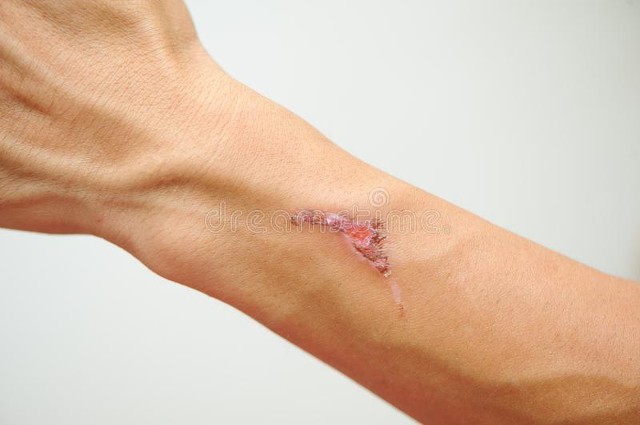 全切双眼皮疤痕增生多久可以变平,凸起增生疤痕怎么变平