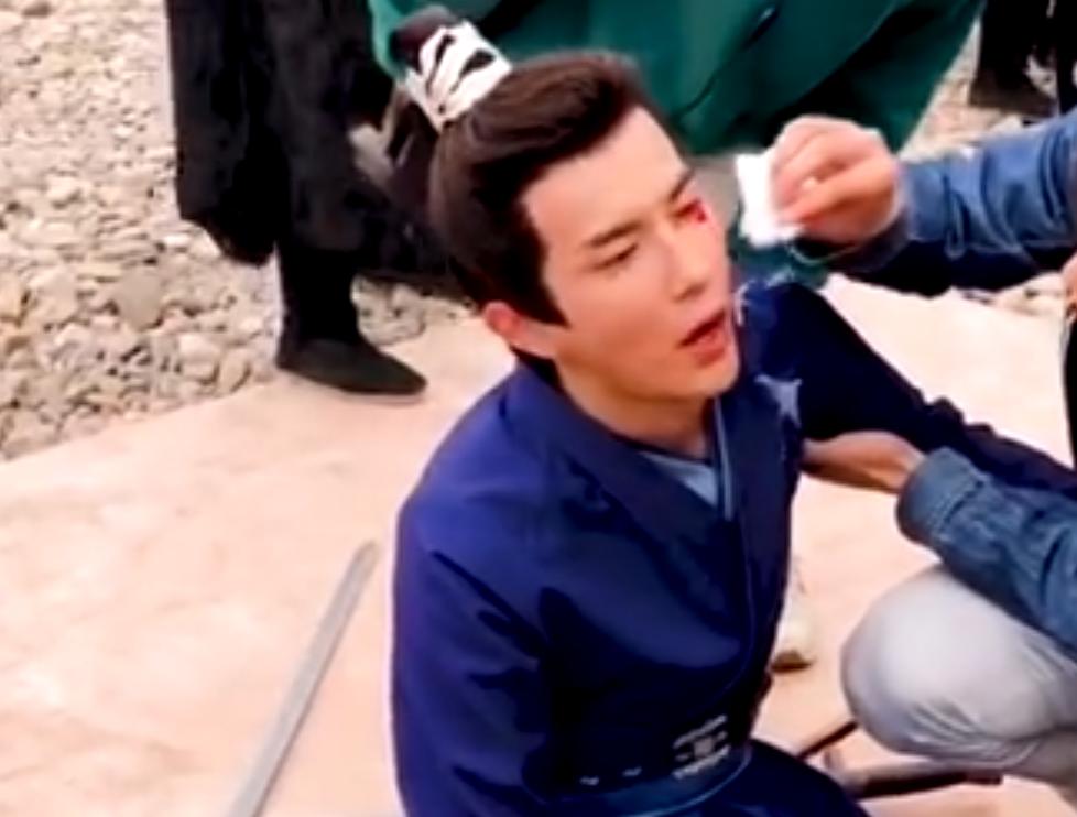 于朦胧剧组受伤视频曝光，左眼被戳流血不止，曾拍戏摔伤五处骨折