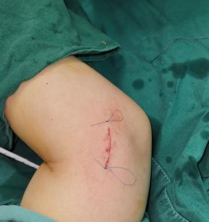 手臂肘关节疼最快的自愈方法,网球肘手腕疼自我锻炼恢复方法