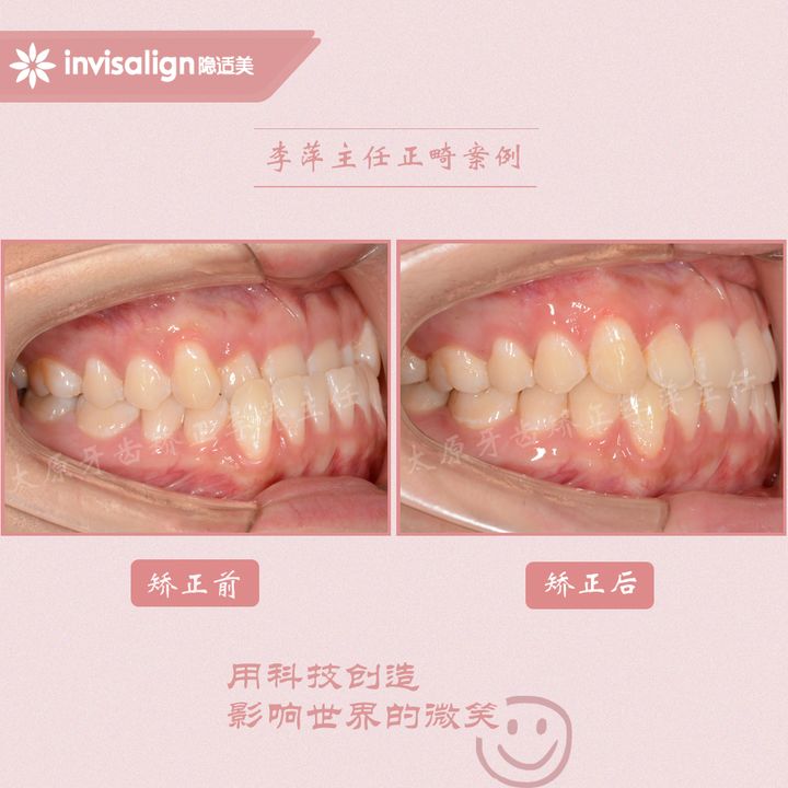 太原矫正牙齿需要做正颌吗,太原牙齿二次矫正