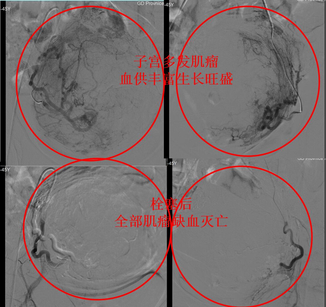 多发子宫肌瘤到底长在哪里了,子宫肌瘤一堆怎么治疗