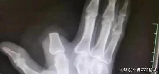 被五步蛇咬了真的不能走五步吗,为什么被五步蛇咬到只能走五步