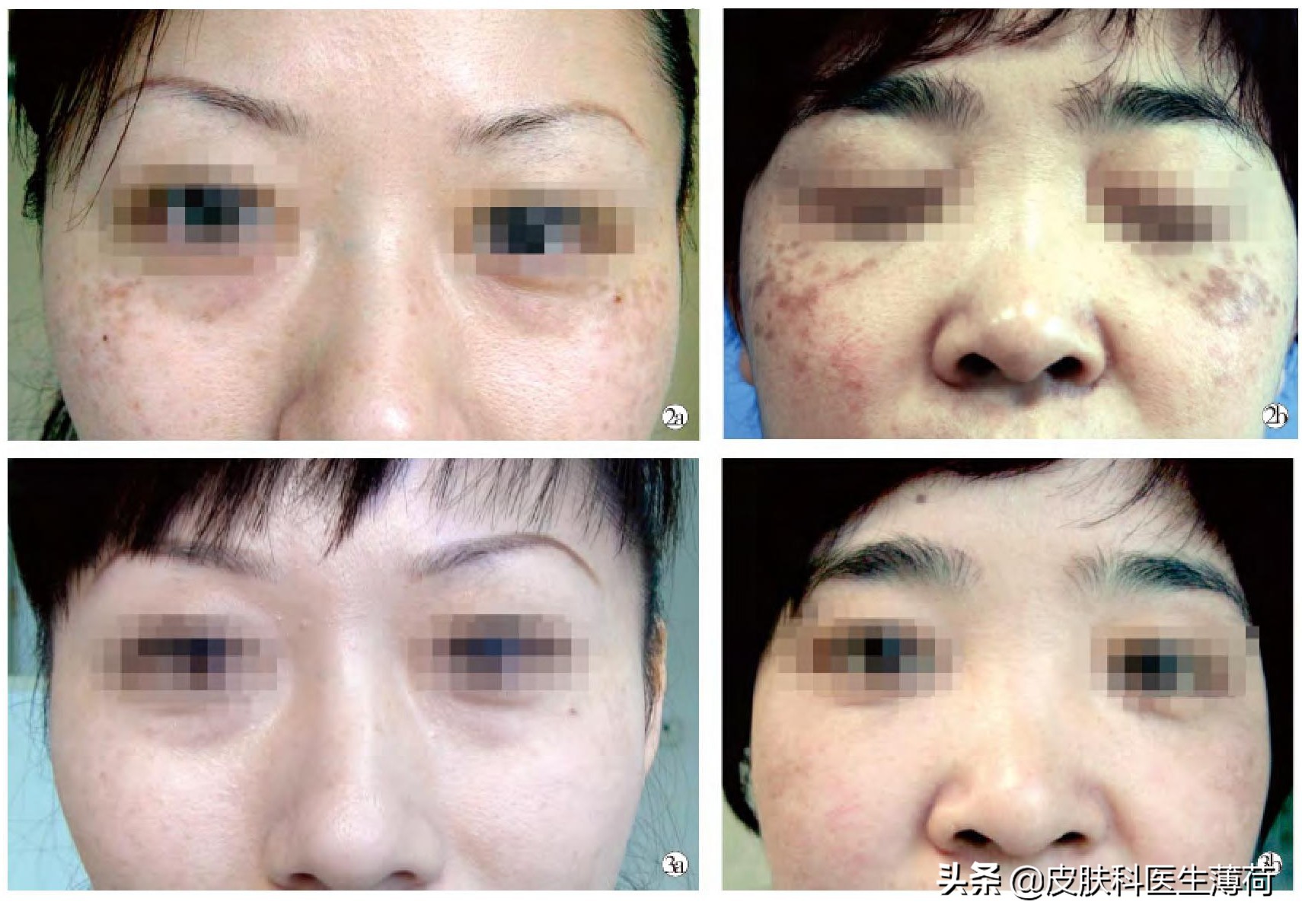 中药点斑好还是激光祛斑好,脸上有斑打激光过后吃有讲究吗