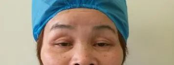 眼整形修复权威科普,科普眼整形手术是个什么手术多图