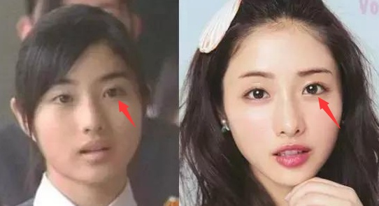 眼睛太圆了怎么修复双眼皮,眼睛已经是双眼皮太小了怎么变大