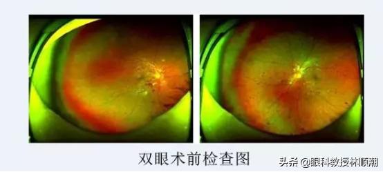 关于糖尿病视网膜病变的20个问题,22岁糖尿病人的真实经历