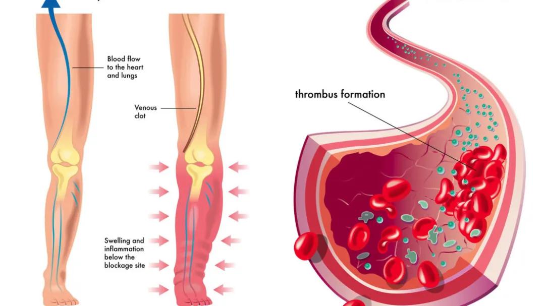 老年人打清血针好吗,清除血管垃圾输液用什么药