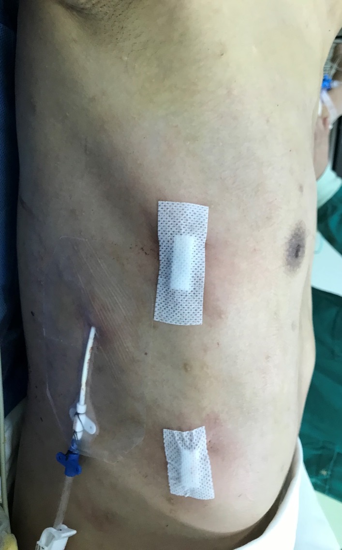 今天的Wenlin手术：桶状胸的微创矫治手术