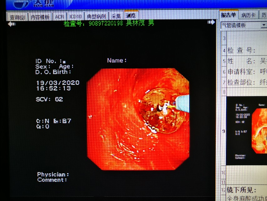 经支气管镜球囊扩张治疗气道狭窄,支气管镜球囊扩张操作视频
