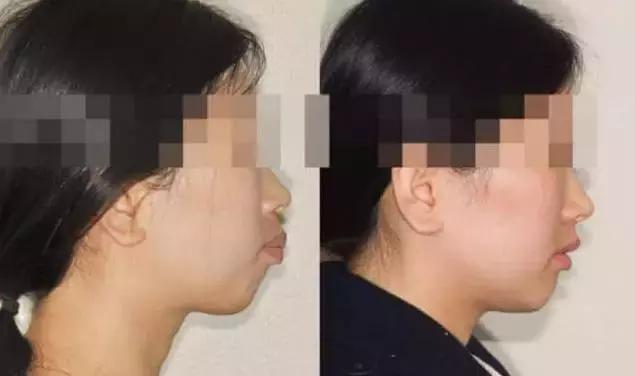 龅牙牙齿矫正的最佳方法,龅牙凸嘴露龈笑