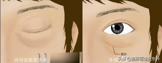 眼袋手术的真实感受,做过眼袋的人视频
