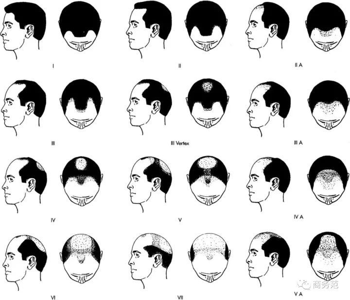 威廉王子秃顶了哈里为啥没秃顶,威廉王子为什么喜欢秃顶