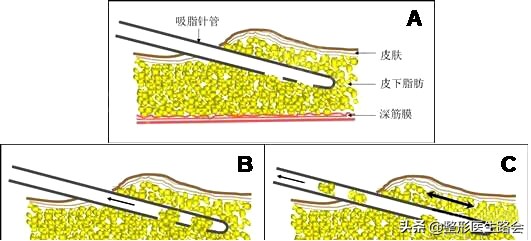 下颌角整形│对不起，你的脸让我的心好“方”