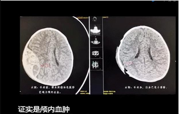 宝宝不小心磕到头怎么办动画,宝宝不小心摔倒磕到前面头部