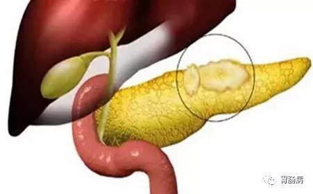 一般什么病会误诊为胃病,什么病容易误诊为胃病