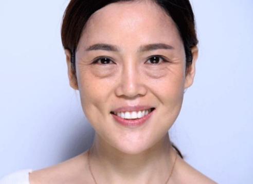 眼袋黑眼圈严重怎么治疗,眼袋黑眼圈怎么治