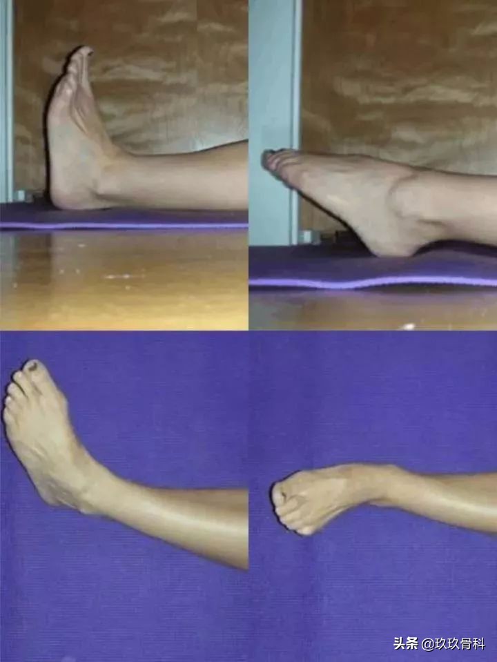 脚踝扭伤一个月后康复训练法,脚踝扭伤是否需要康复训练