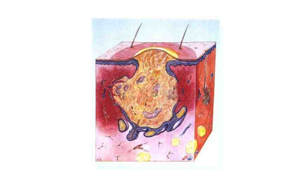 如何分辨痘痘的类型和长痘的原因,如何判断自己长的痘痘是哪种痘痘