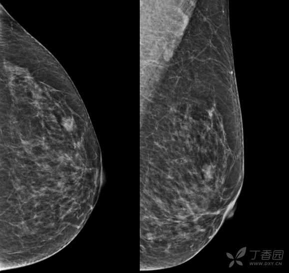 乳腺结节有消散的病例吗,一份完整的乳腺增生病例