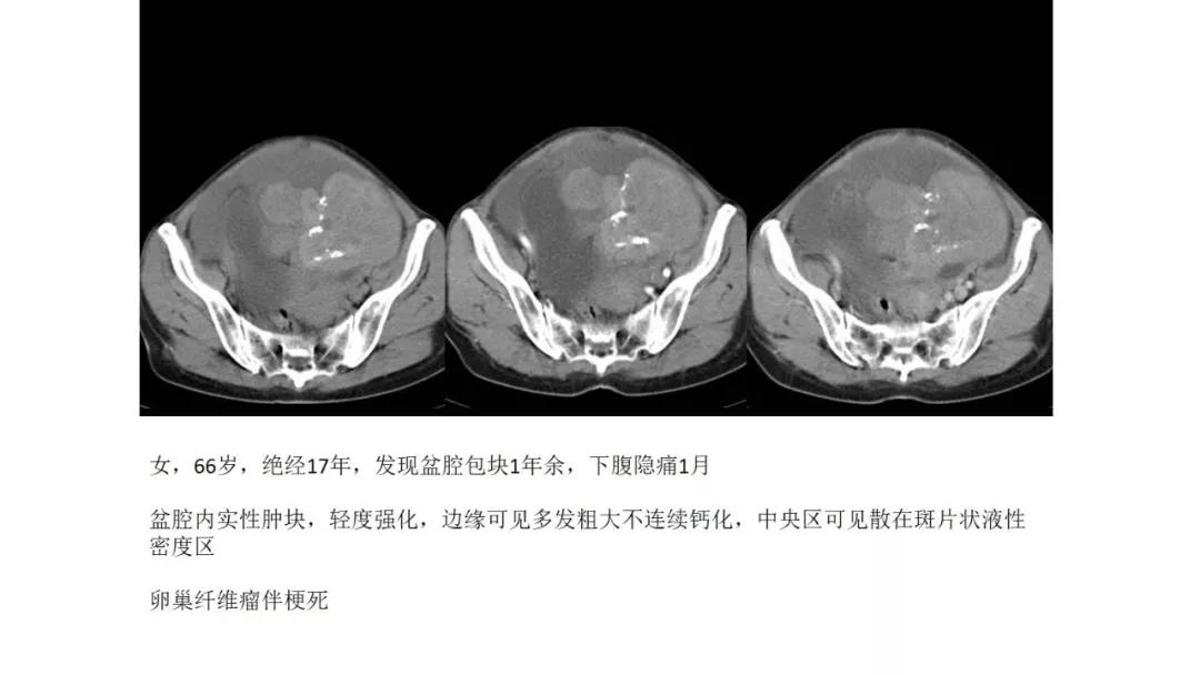 卵巢原发肿瘤的分析思路