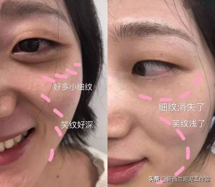 吴昕同款祛黄脸,吴昕眼袋