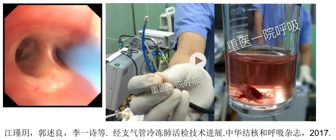 经皮肺穿刺活检术过程,经支气管冷冻肺活检