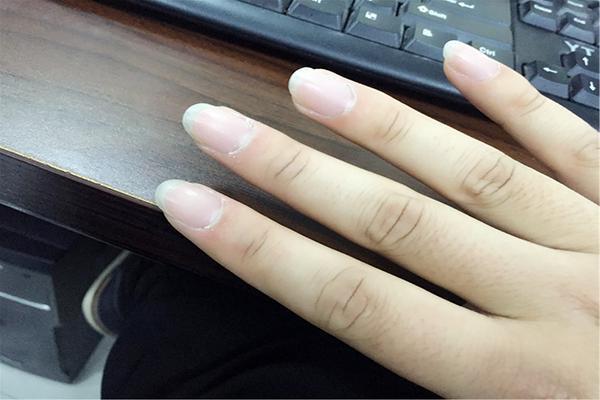 脚趾指甲一道横凹沟,左脚大拇指指甲中间有一条凹沟