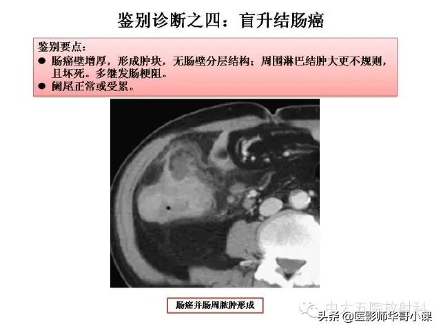 阑尾炎课件,阑尾炎的超声课件