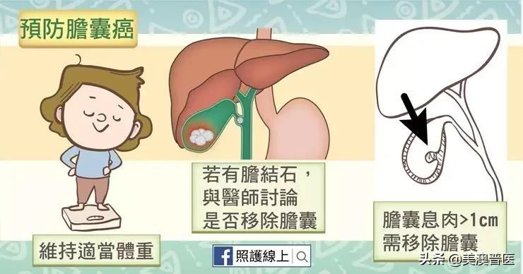 胆结石不治疗多久会转变为癌,胆结石不治疗会越来越严重吗