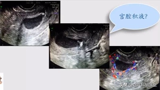 检查妇科说有积液了是怎么了,体检提示盆腔积液