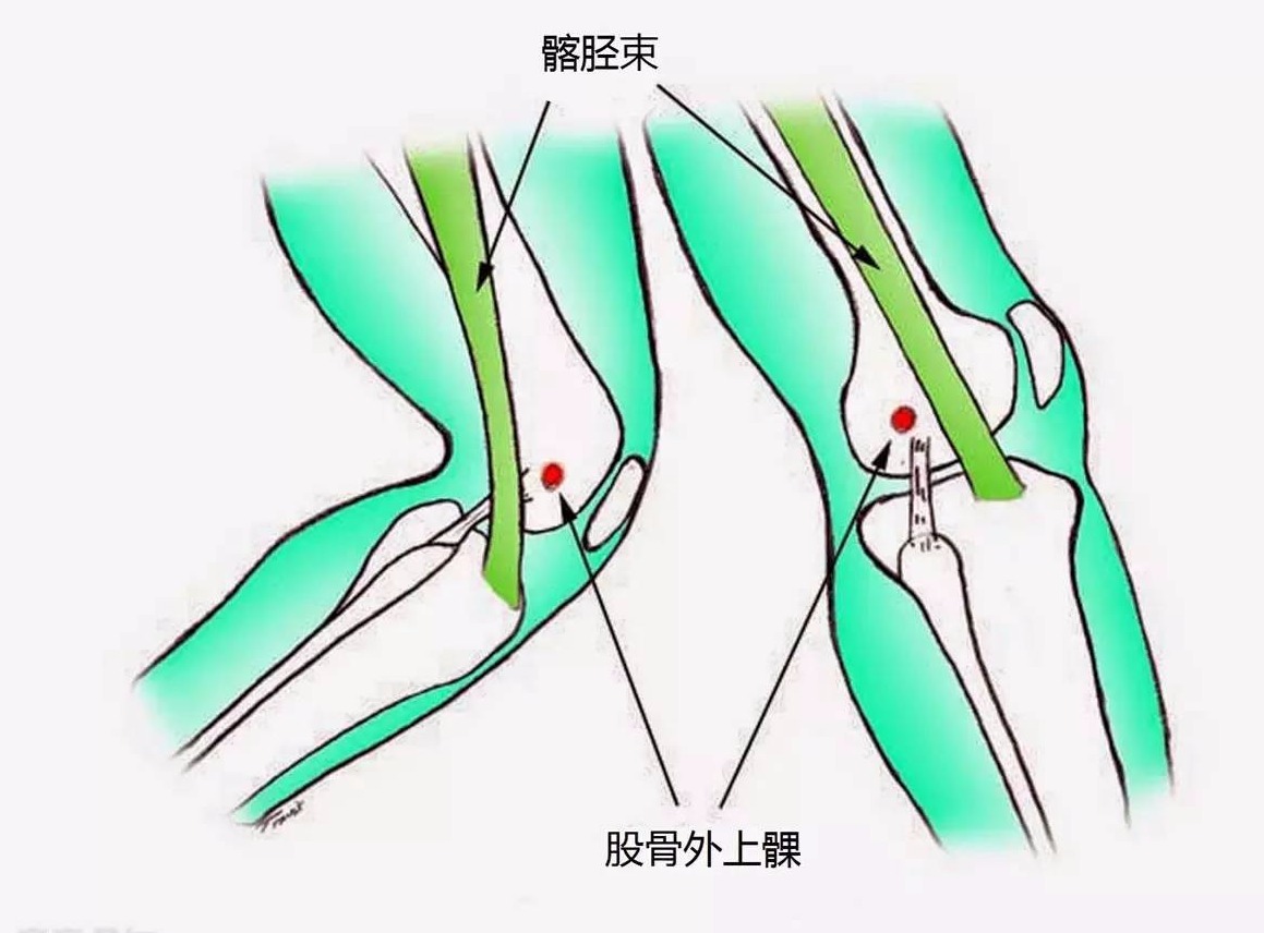 跑步对膝盖的正确训练,错误跑步姿势小腿疼怎么办