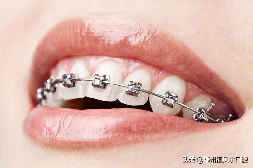 干货牙齿矫正的几个疑问为你解答,牙齿矫正过来人教你怎么避坑