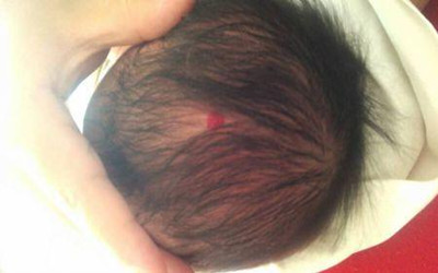 小孩身上的血管瘤饮食要注意什么,婴儿草莓状血管瘤需要注意什么