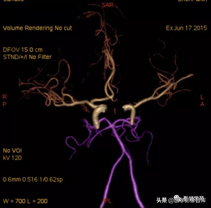 鞍区肿瘤做什么检查得出来,鞍区肿瘤的影像学鉴别