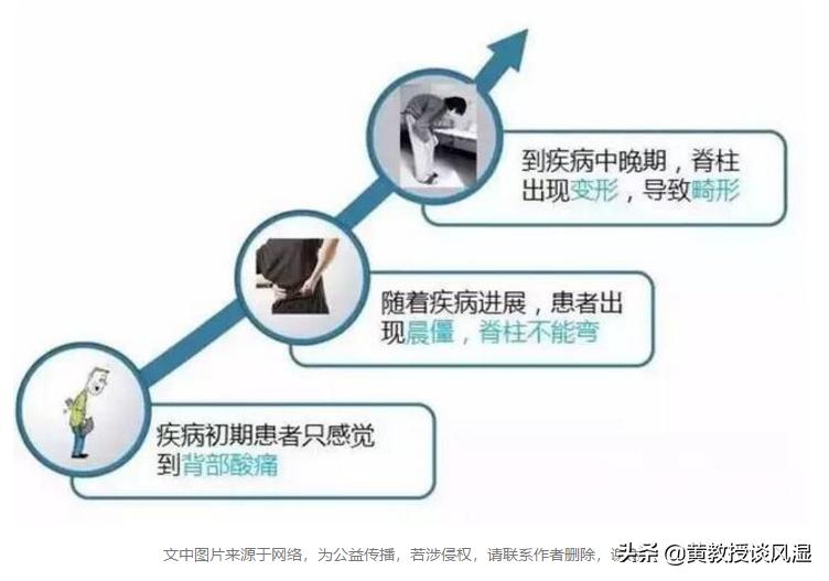 高中生熬夜学习，早上起床腰痛不已元凶：得了强直性脊柱炎